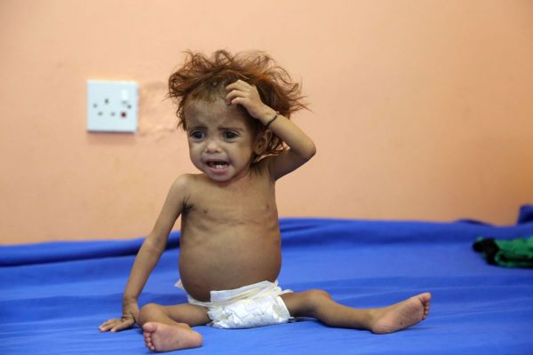Zo ziet een ondervoed kind eruit in oorlogsgebied Jemen
