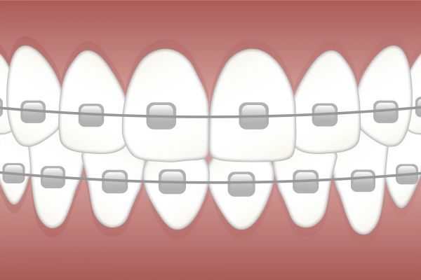 Wat een woord zeg... orthodontie!